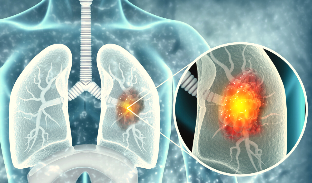 lung cancer.jpg